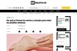Por qué se forman las varices y consejos para tratar los posibles síntomas