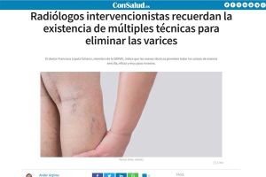 Radiólogos intervencionistas recuerdan la existencia de múltiples técnicas para eliminar las varices