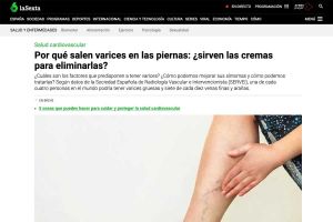 ¿Por qué salen las varices en las piernas? La Sociedad Española de Radiología Vascular e Intervencionista nos explica cómo prevenirlas y qué tratamientos tienen las varices en las piernas