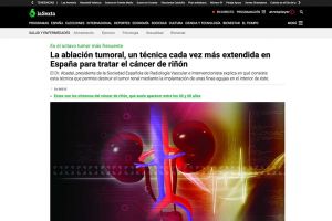 La ablación tumoral es una técnica muy precisa que destruye el tumor y mantiene intacto el tejido sano 