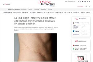 La Radiología Intervencionista ofrece tratamientos mínimamente invasivos para el cáncer de riñón