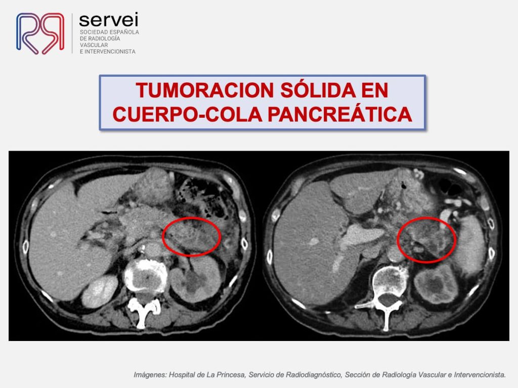 Biopsia pancreatica transgastrica_02