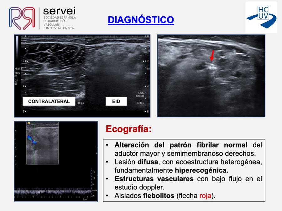 Crioablacion-anomalia-vascular-fibroadiposa_03