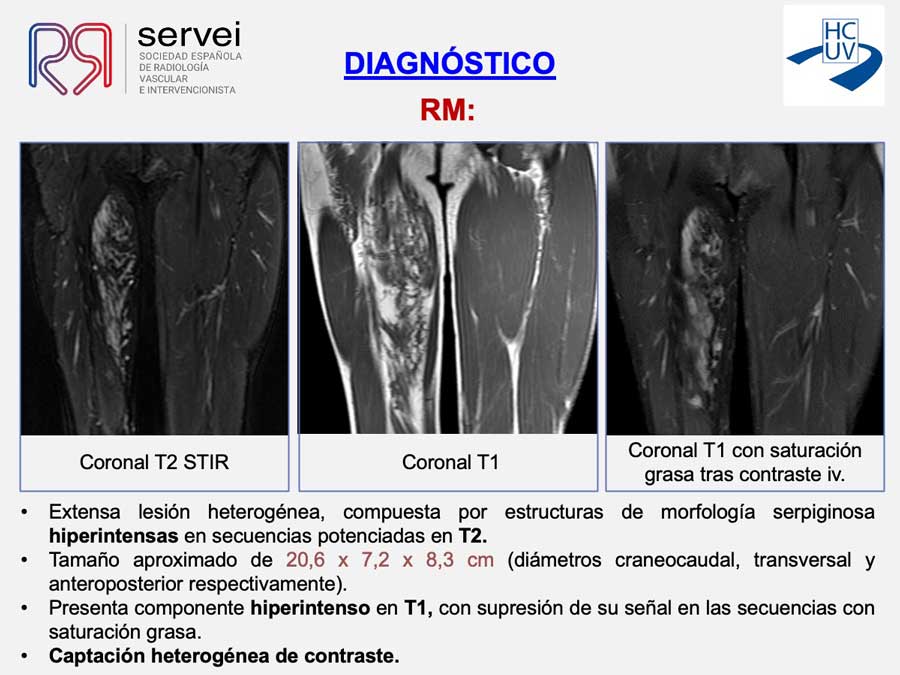 Crioablacion-anomalia-vascular-fibroadiposa_04