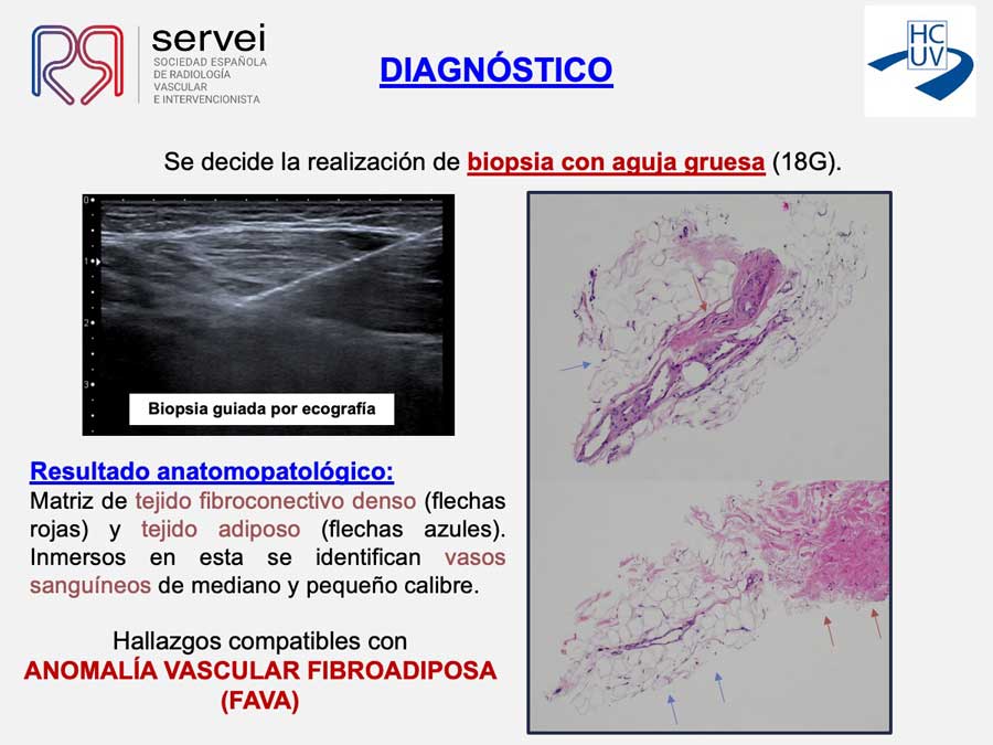Crioablacion-anomalia-vascular-fibroadiposa_05