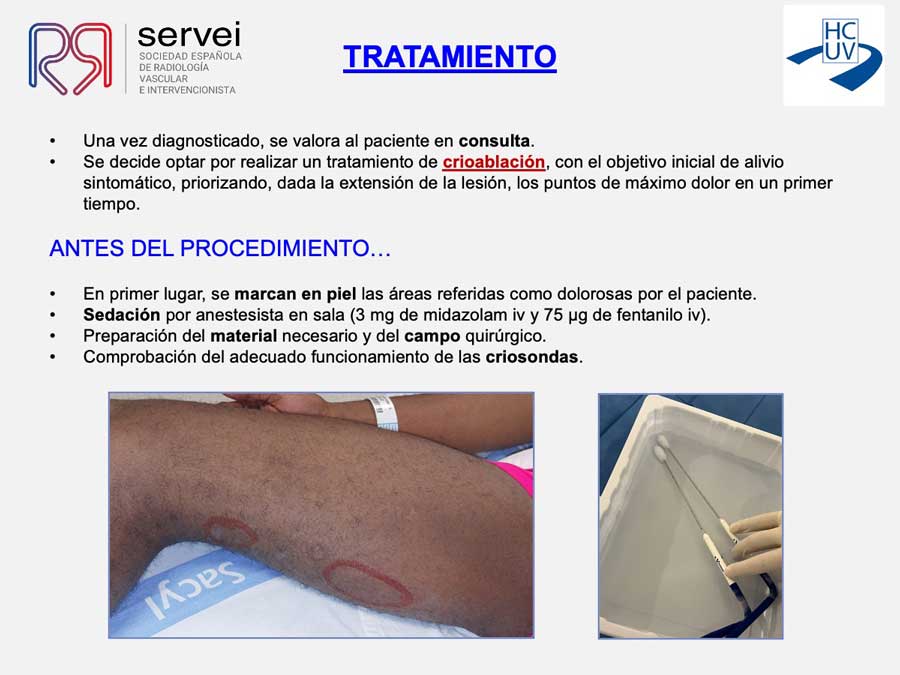 Crioablacion-anomalia-vascular-fibroadiposa_06