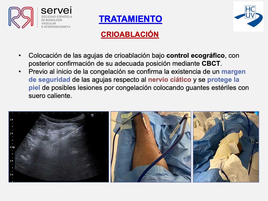 Crioablacion-anomalia-vascular-fibroadiposa_07