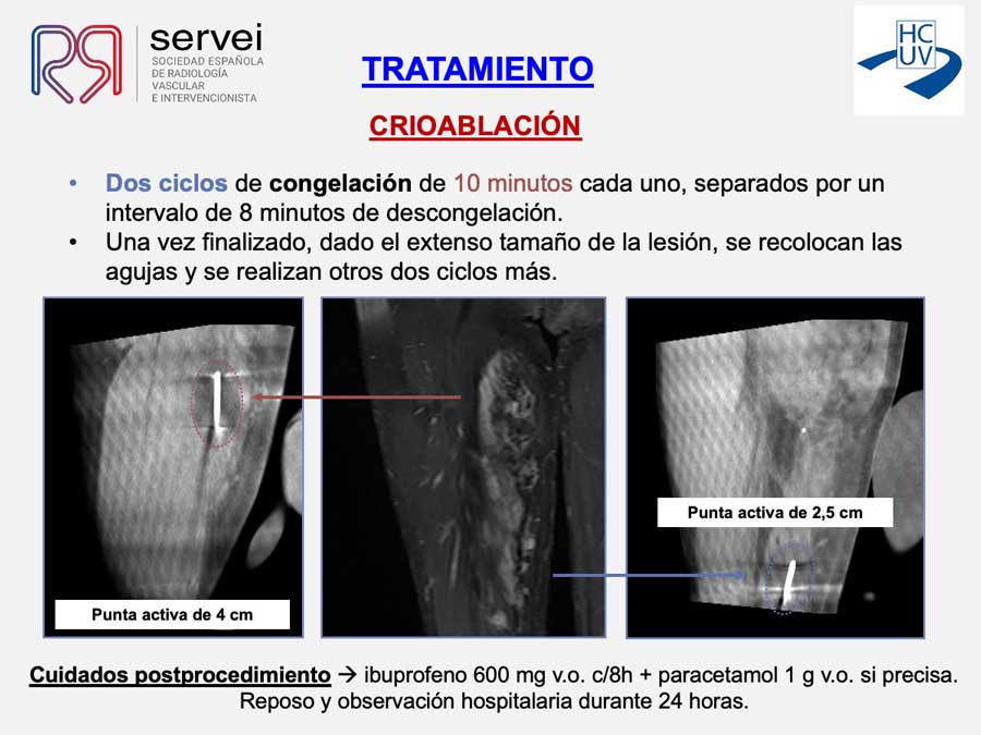 Crioablacion-anomalia-vascular-fibroadiposa_08
