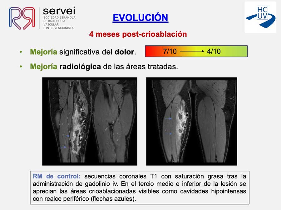 Crioablacion-anomalia-vascular-fibroadiposa_09