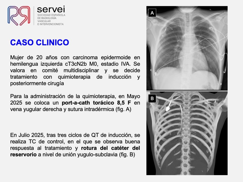 Embolizacion cuerpo extraño vena safena_02