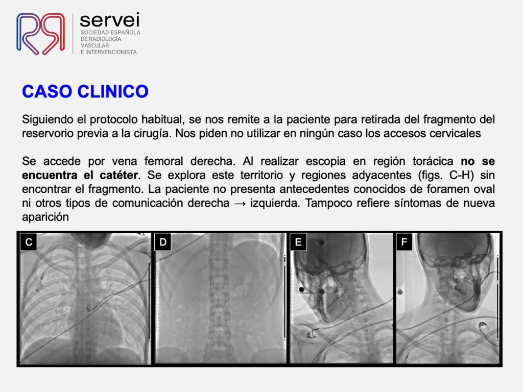 Embolizacion cuerpo extraño vena safena_03