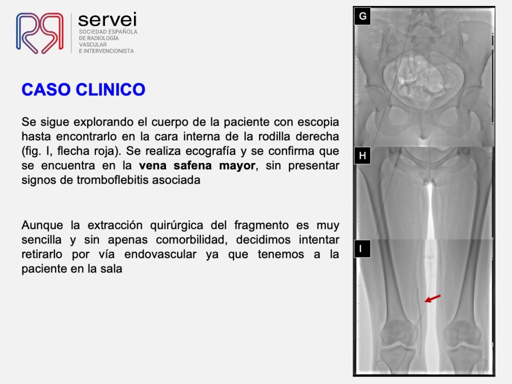 Embolizacion cuerpo extraño vena safena_04