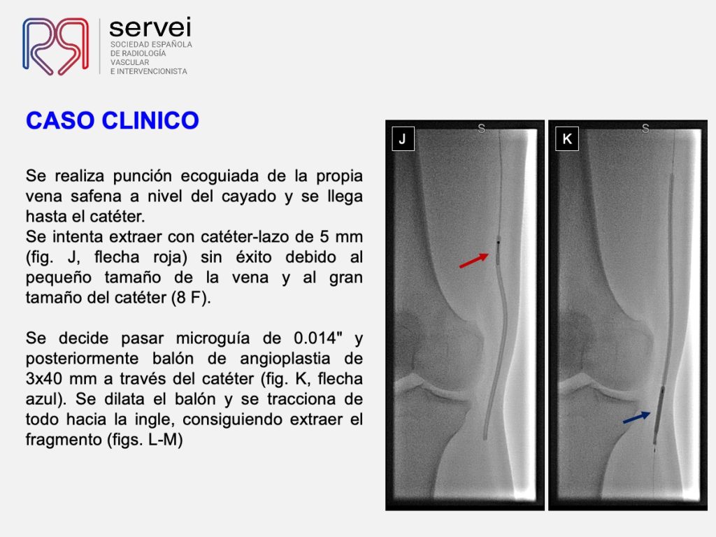 Embolizacion cuerpo extraño vena safena_05