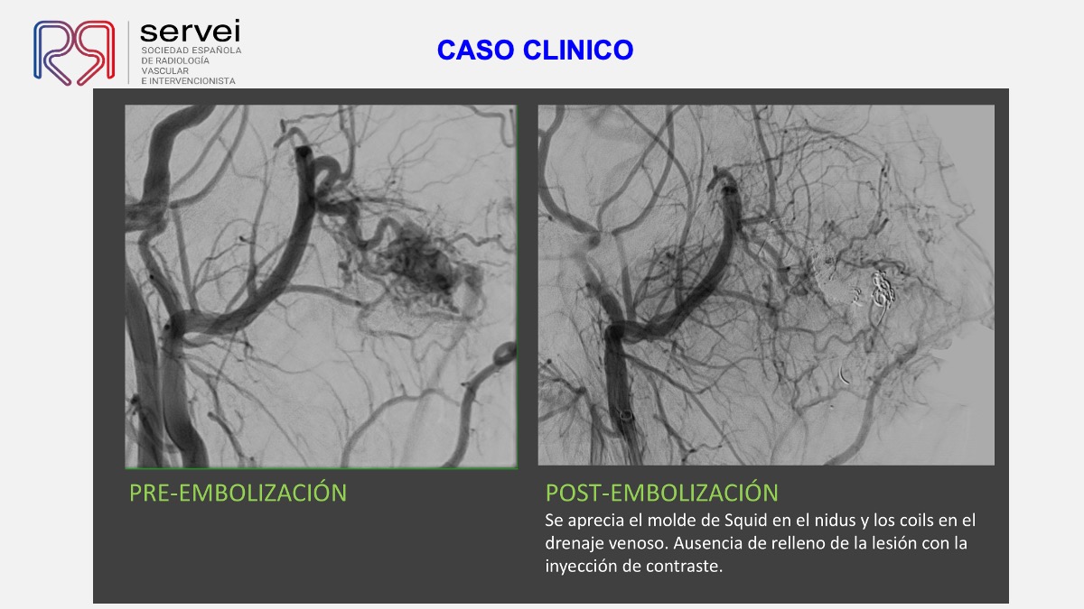 Embolización de malformación arterio-venosa maxilar