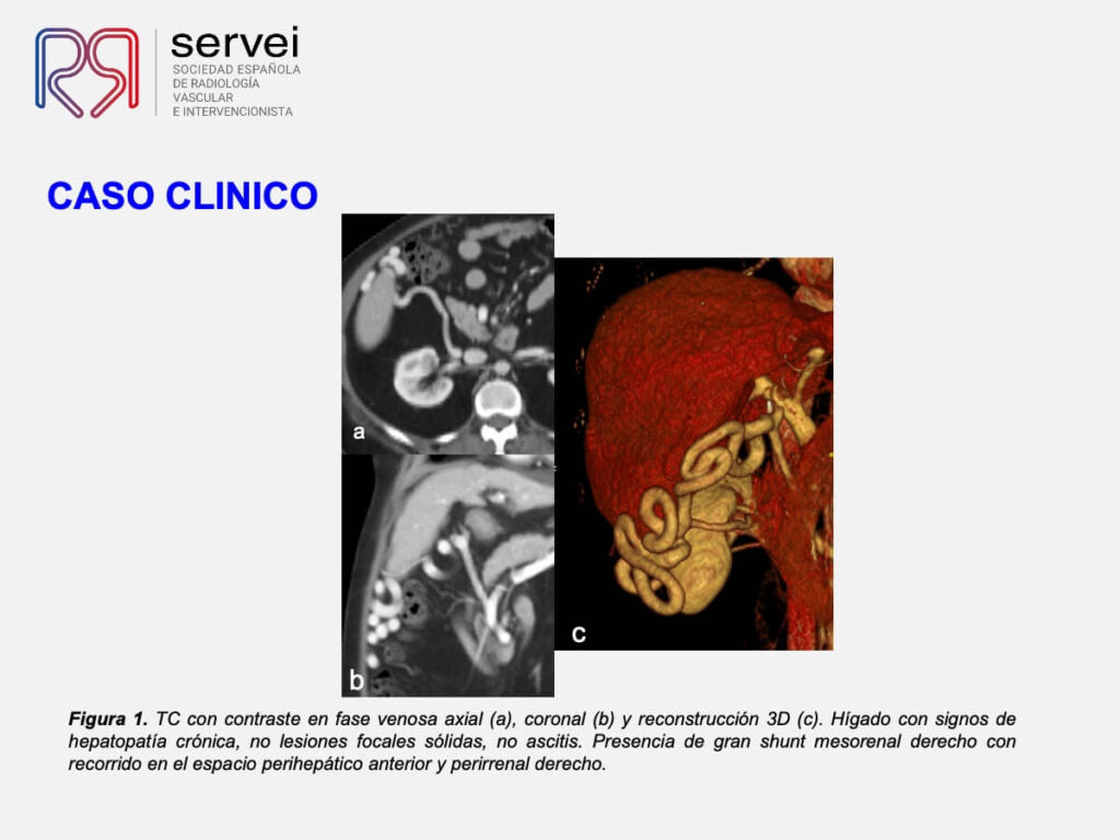 Embolizacion shunt mesorenal_03