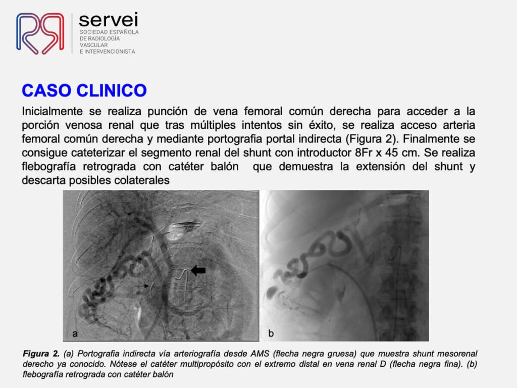 Embolizacion shunt mesorenal_04