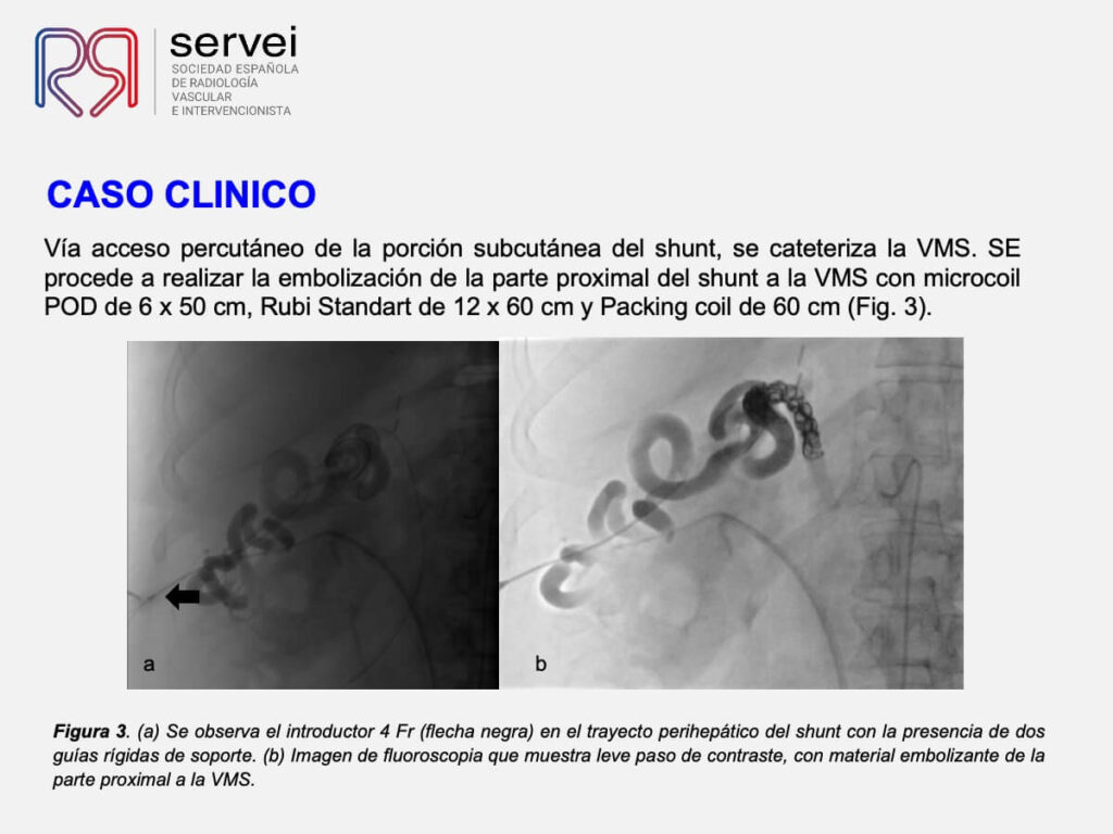 Embolizacion shunt mesorenal_05