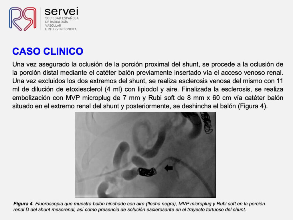 Embolizacion shunt mesorenal_06