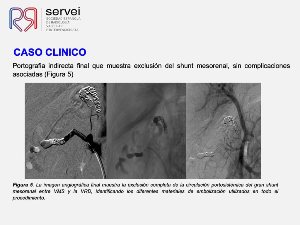 Embolizacion shunt mesorenal_07