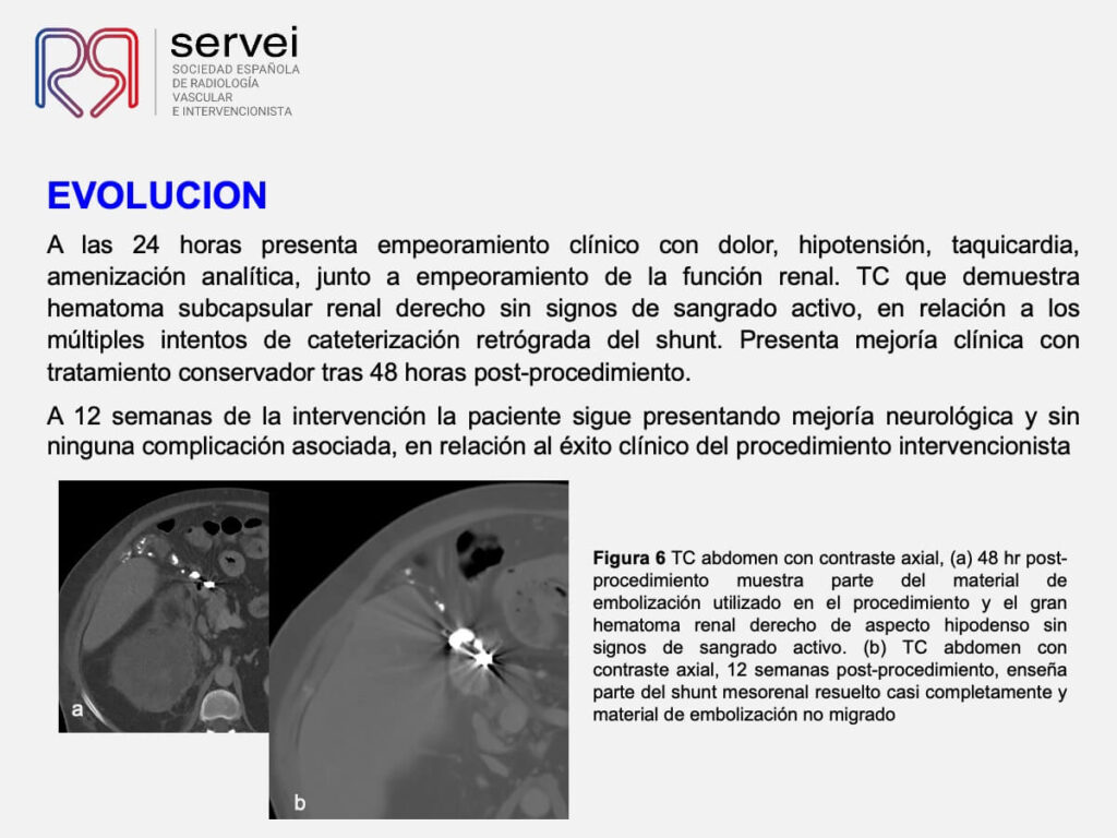 Embolizacion shunt mesorenal_08