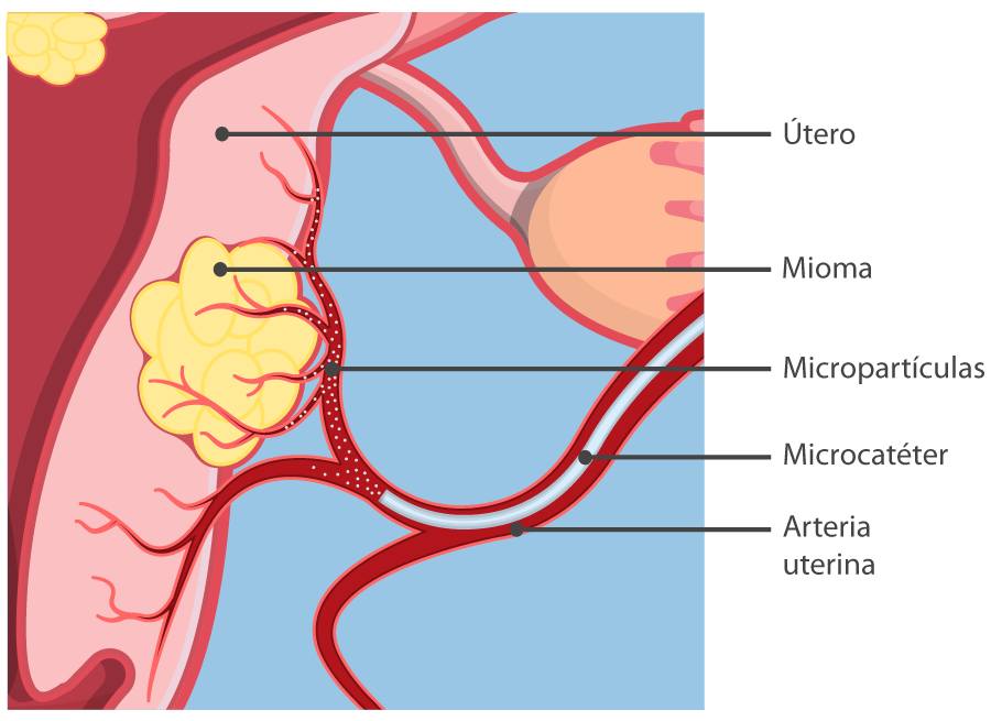 Introducción de micropartículas. Embolización miomas uterinos