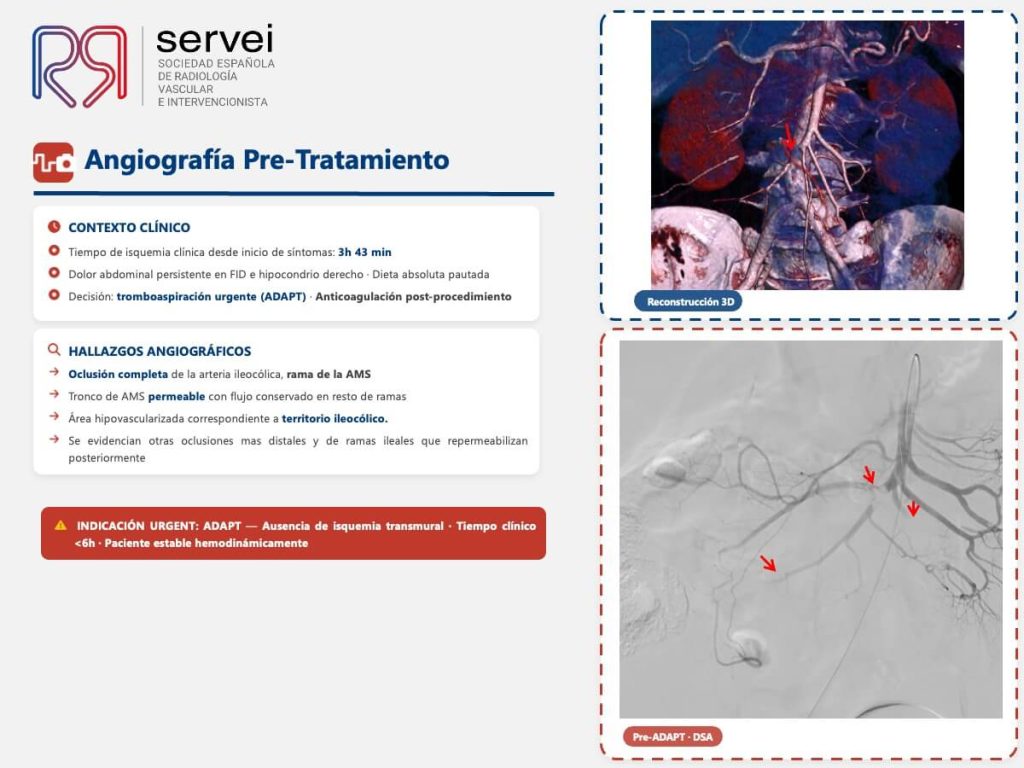 Isquemia mesenterica tecnica ADAPT_04