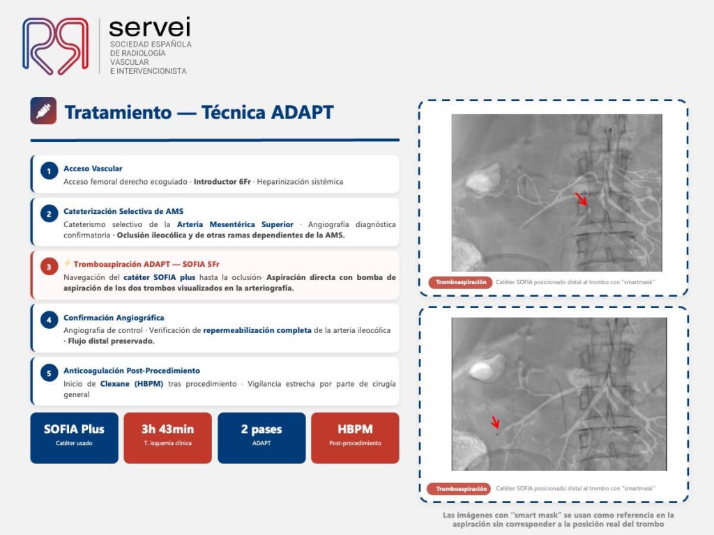 Isquemia mesenterica tecnica ADAPT_05