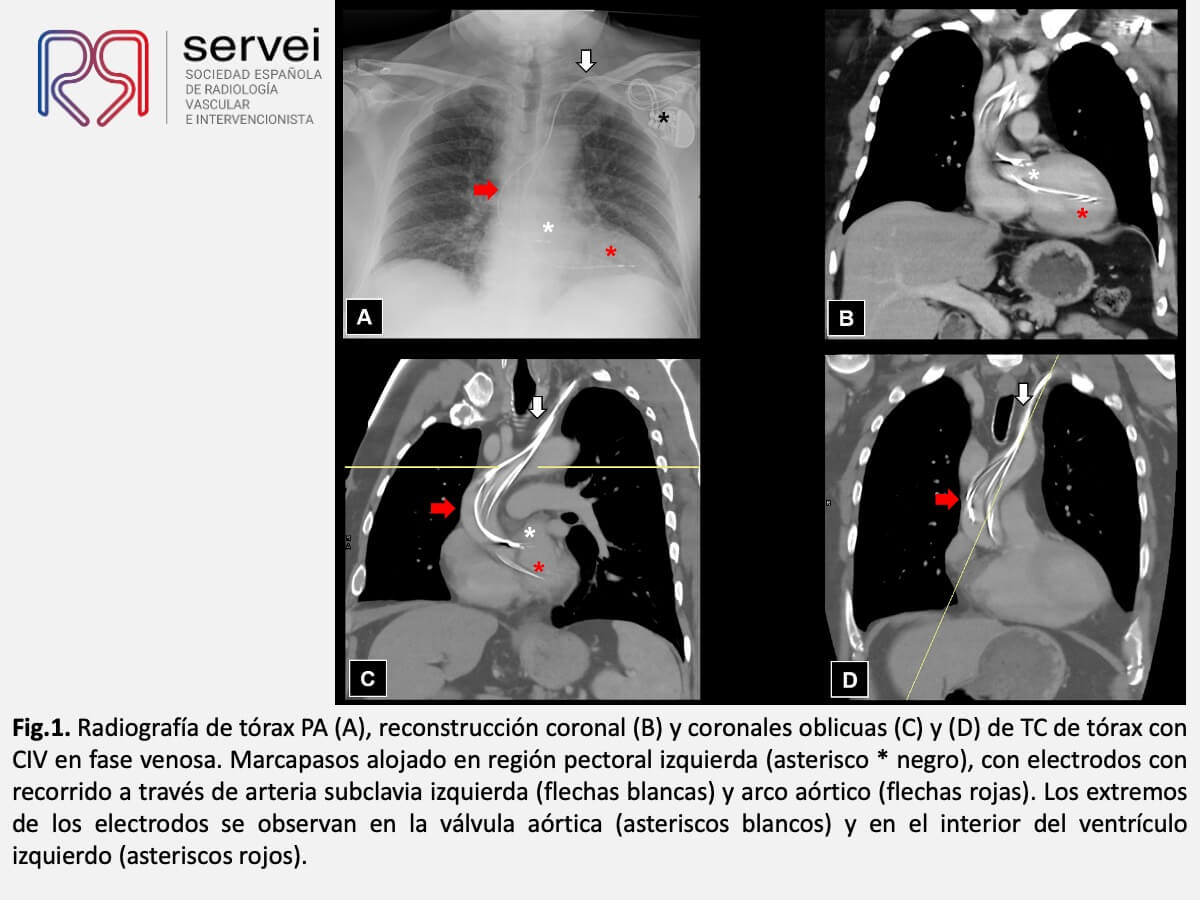 Manejo multidisciplinar malposicionamiento arterial marcapasos_04