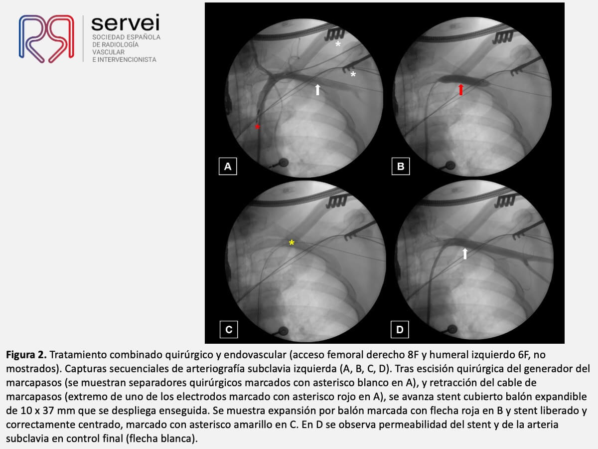 Manejo multidisciplinar malposicionamiento arterial marcapasos_06