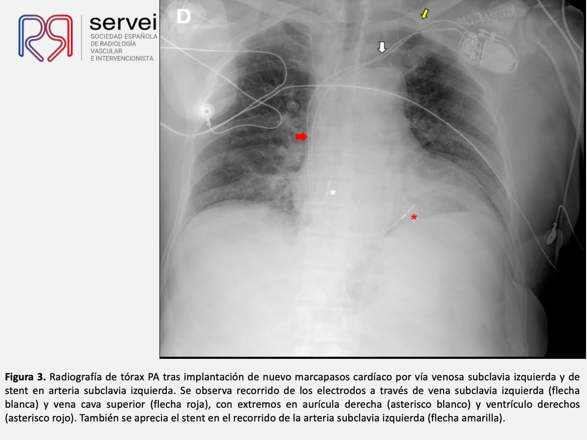 Manejo multidisciplinar malposicionamiento arterial marcapasos_07