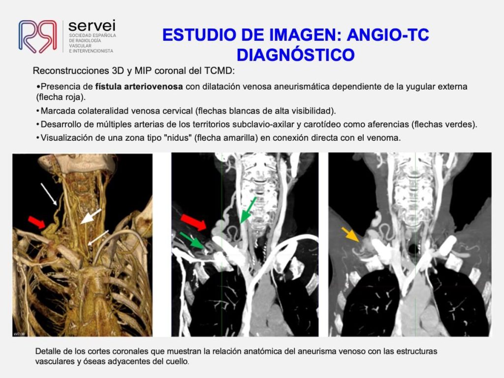 Tecnica olla presion fistula AV_04