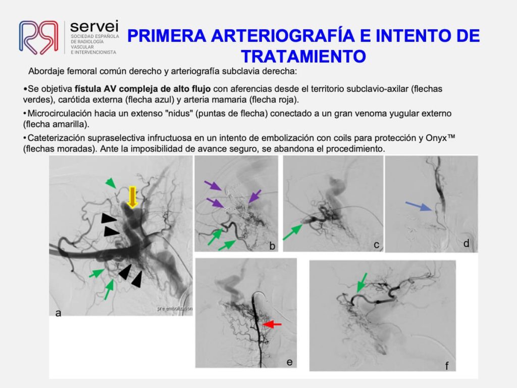 Tecnica olla presion fistula AV_05