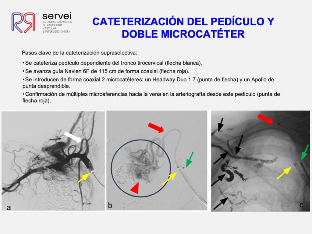 Tecnica olla presion fistula AV_07