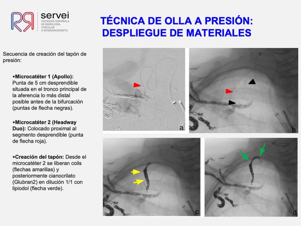 Tecnica olla presion fistula AV_08