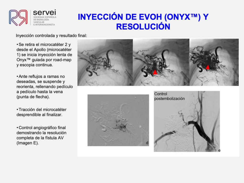Tecnica olla presion fistula AV_09