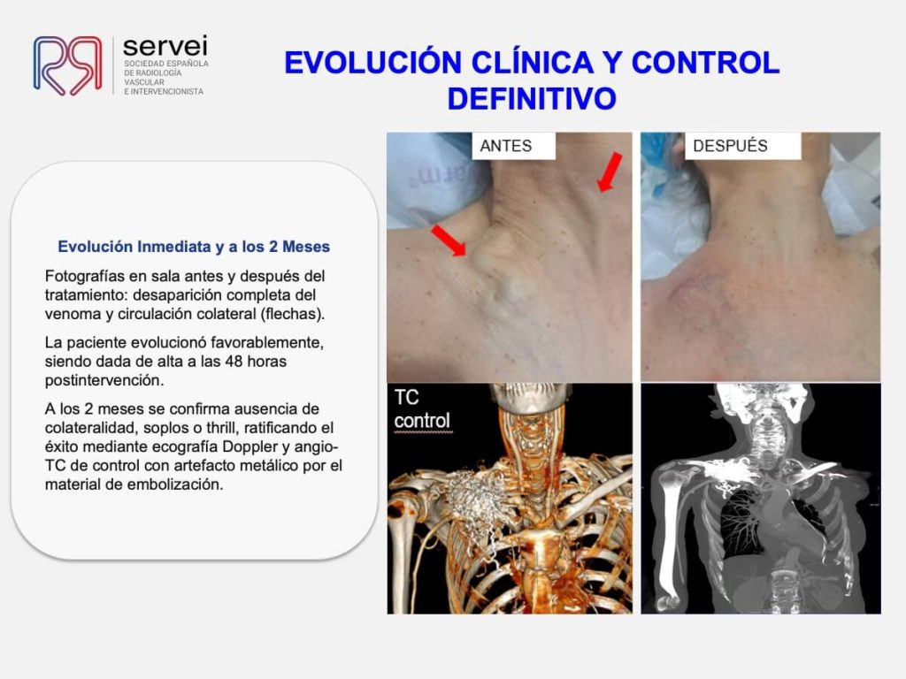 Tecnica olla presion fistula AV_10