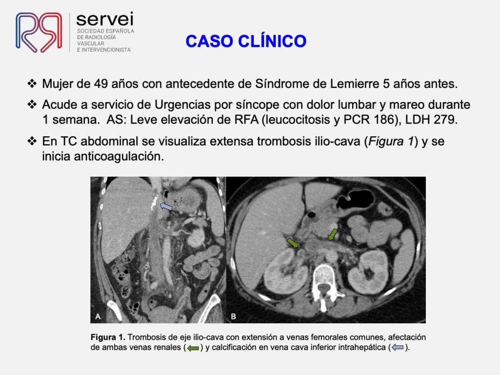 Trombectomia-mecanica-tvp-dolor-lumbar_02