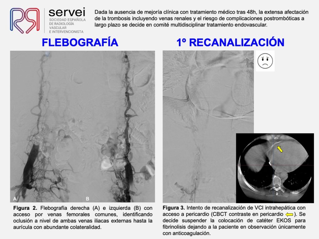 Trombectomia-mecanica-tvp-dolor-lumbar_03