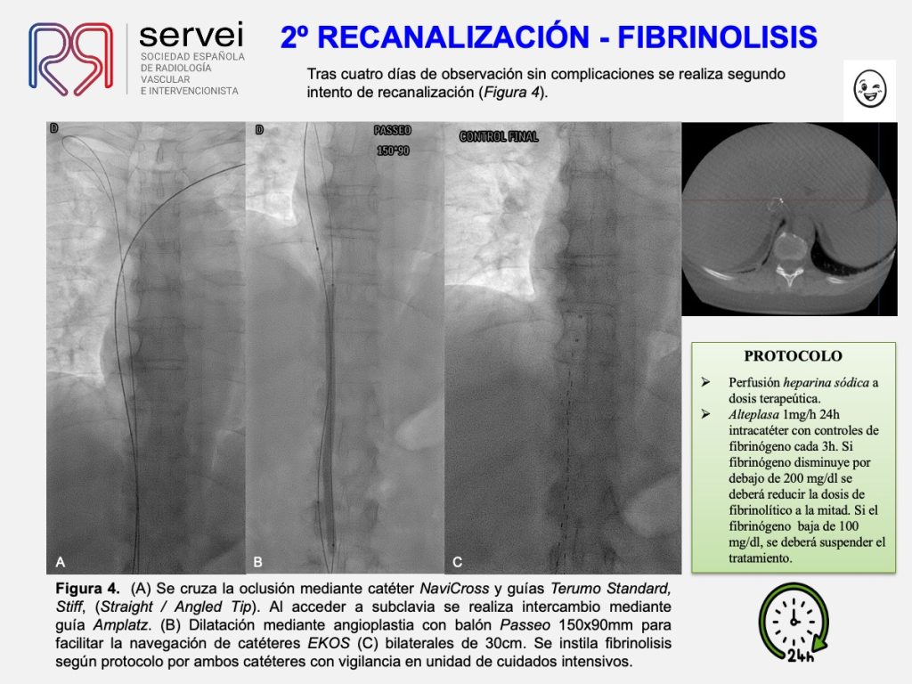 Trombectomia-mecanica-tvp-dolor-lumbar_04