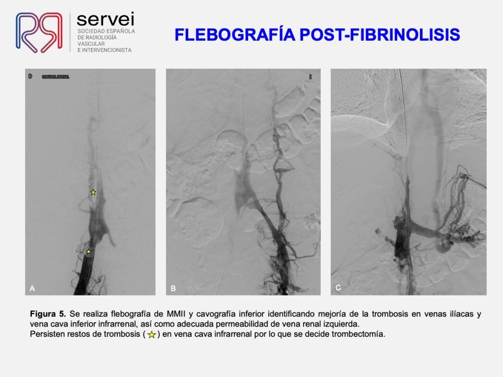 Trombectomia-mecanica-tvp-dolor-lumbar_05