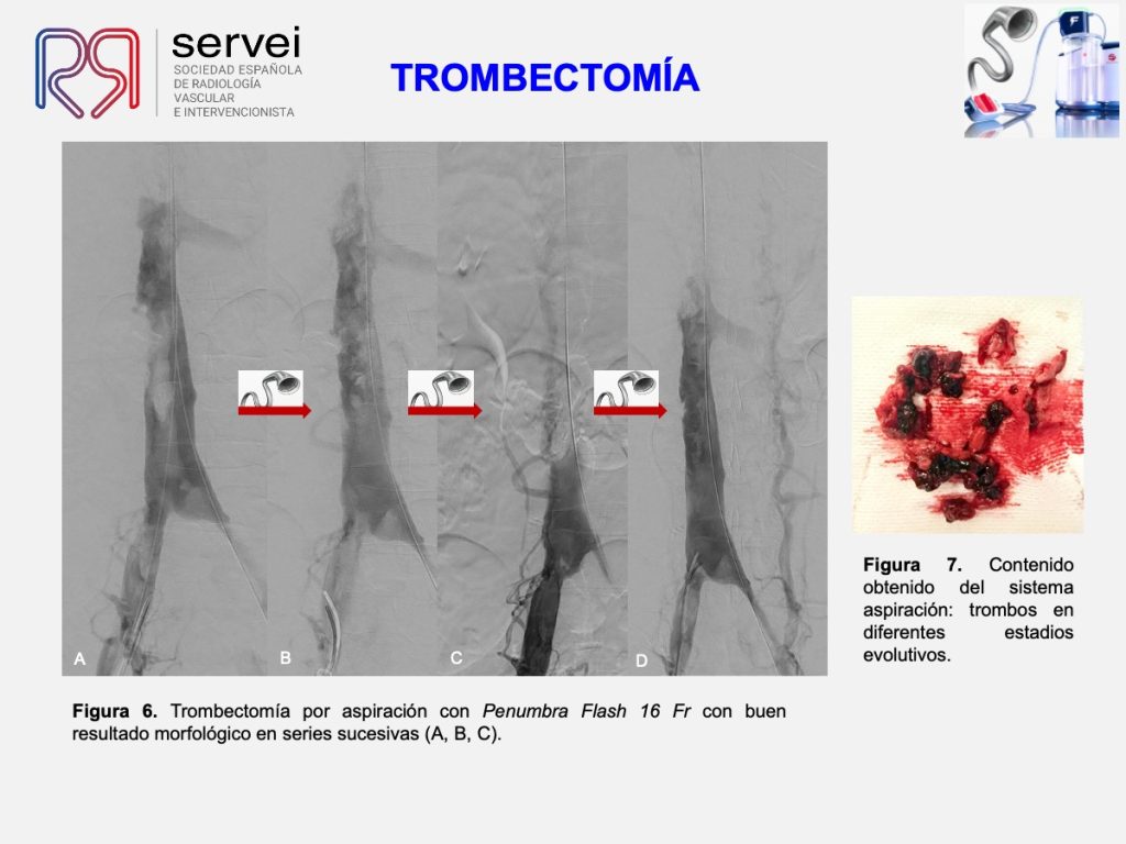 Trombectomia-mecanica-tvp-dolor-lumbar_06