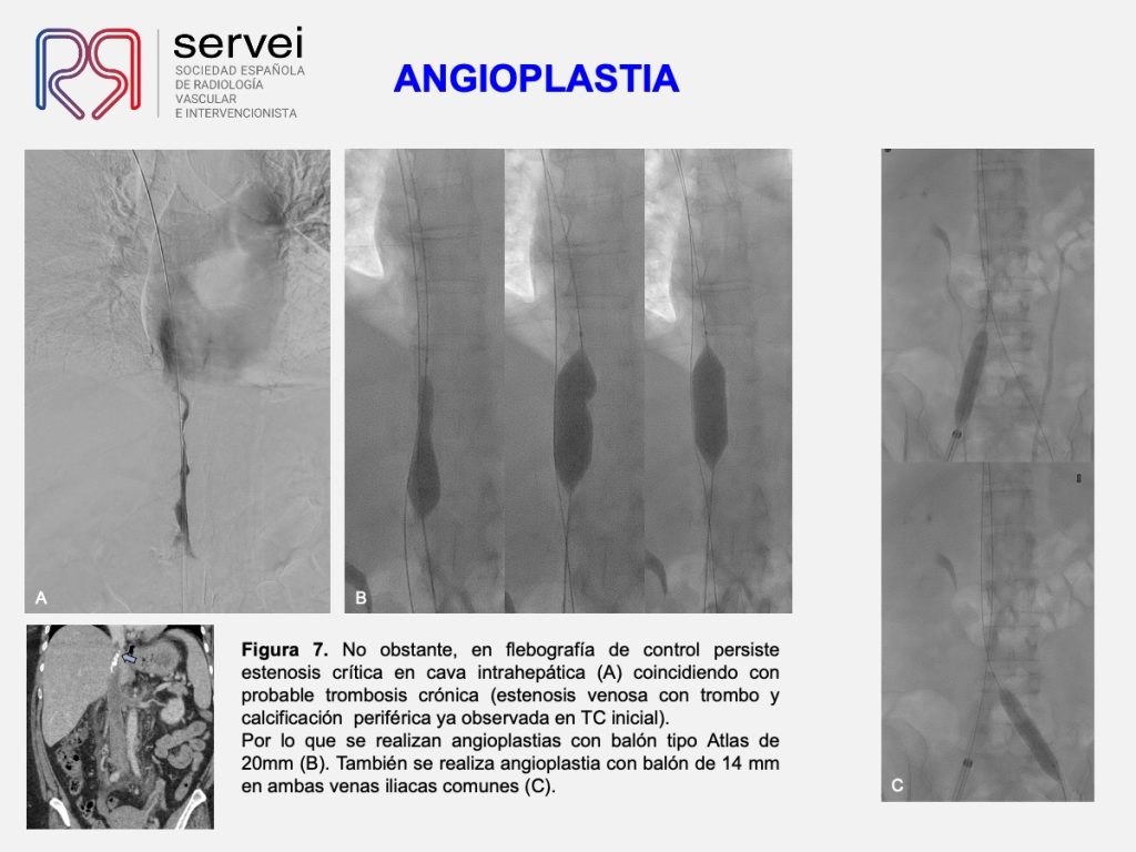 Trombectomia-mecanica-tvp-dolor-lumbar_07