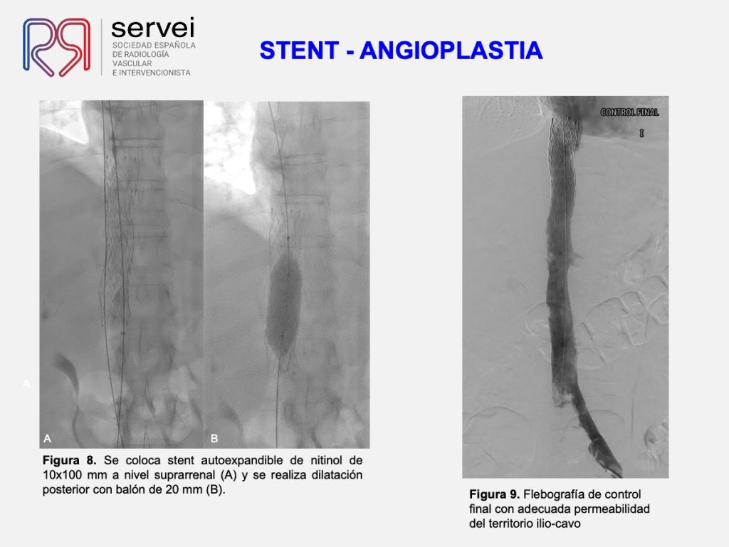 Trombectomia-mecanica-tvp-dolor-lumbar_08