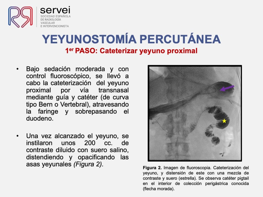 Yeyunostomia percutanea_colocacion_03