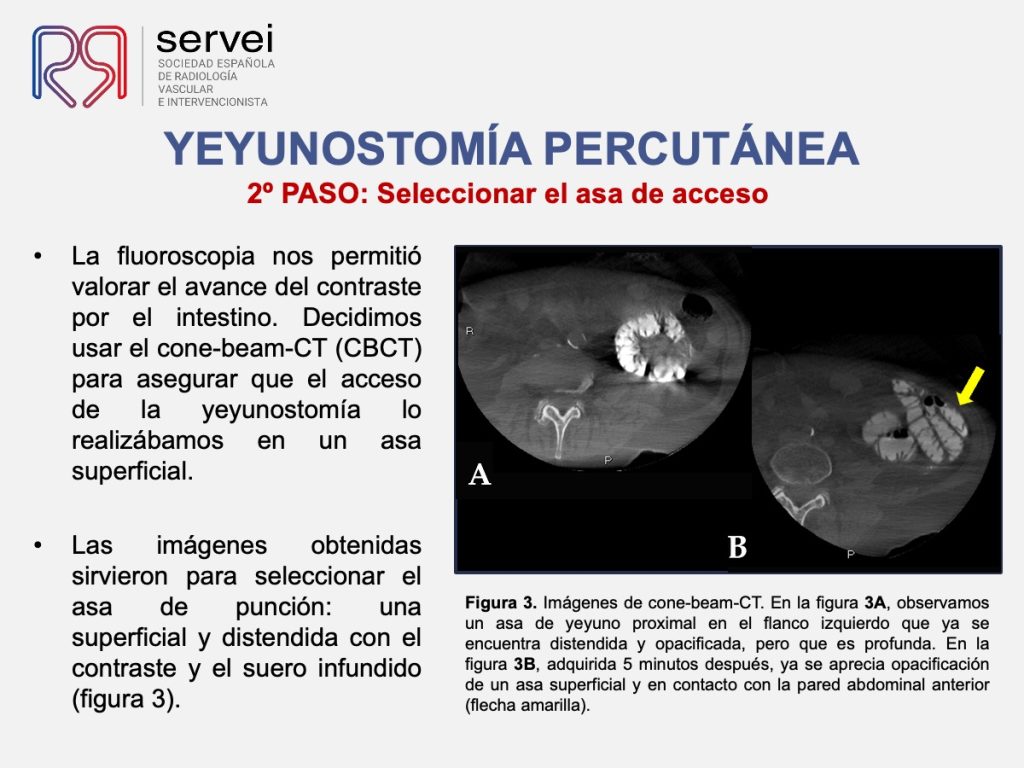 Yeyunostomia percutanea_colocacion_04