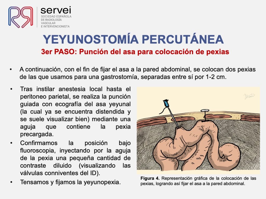 Yeyunostomia percutanea_colocacion_05