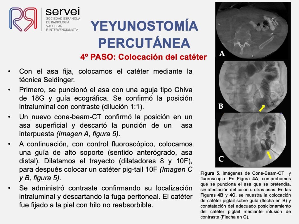 Yeyunostomia percutanea_colocacion_06
