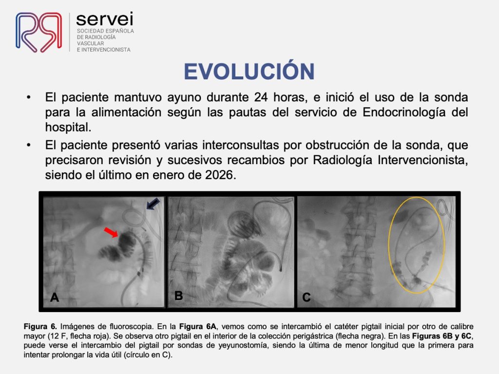 Yeyunostomia percutanea_colocacion_07
