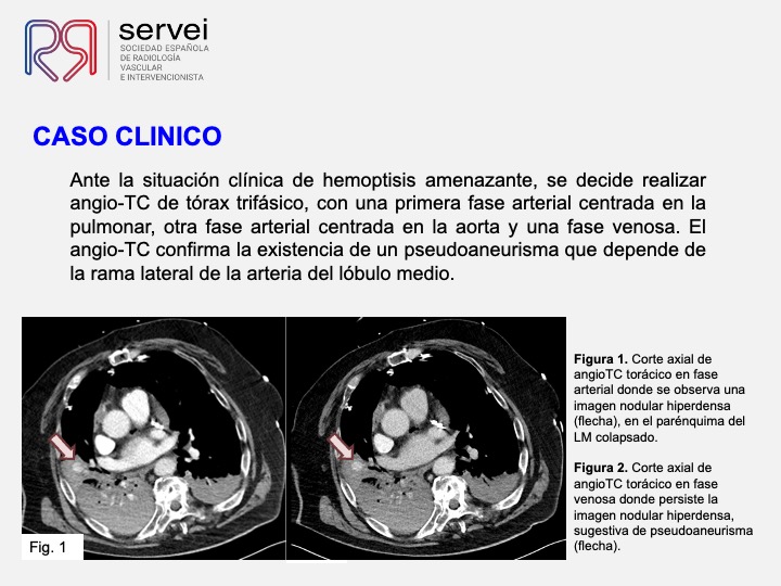 Hemoptisis swan ganz 03