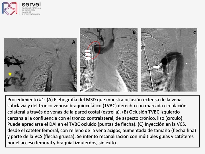 Recanalizacion troncos venosos centrales 03